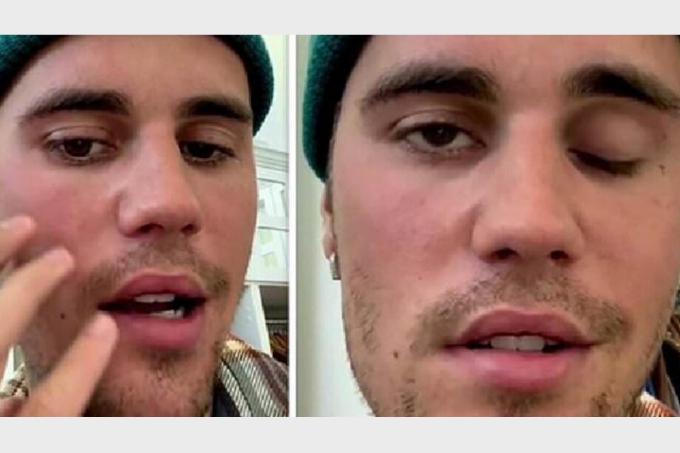 Justin Bieber diagnosed with Ramsay Hunt Syndrome which causes facial paralysis: Keep me in your prayers