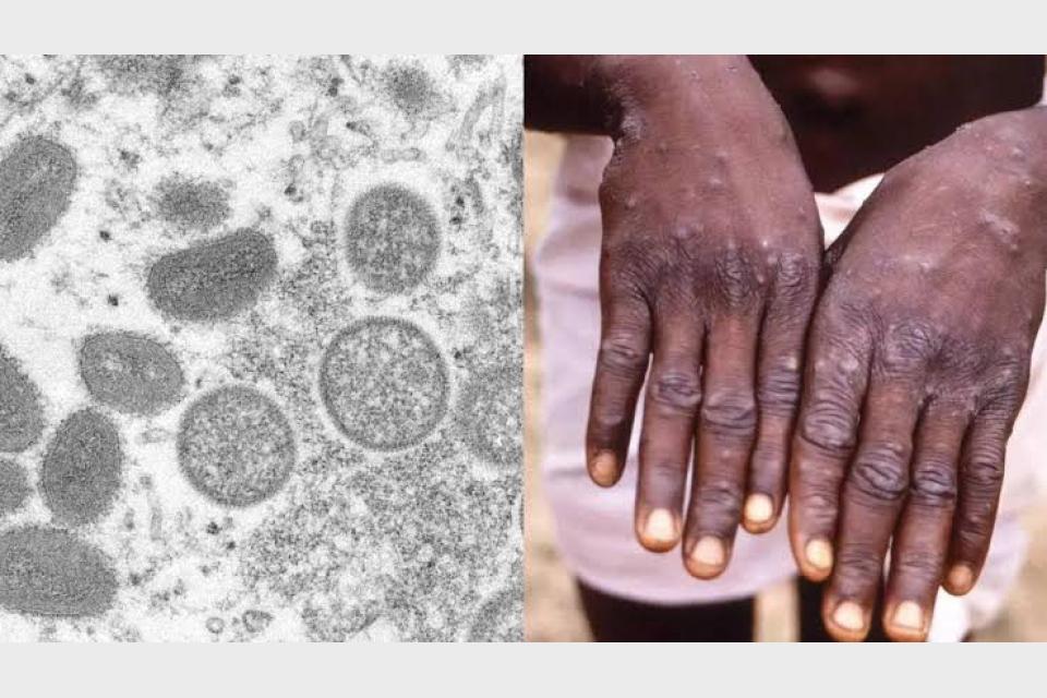 WHO calls for urgent action as Monkeypox cases in Europe triple in two weeks